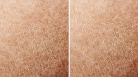 Side by side dry pigmented skin and brighten skin process
