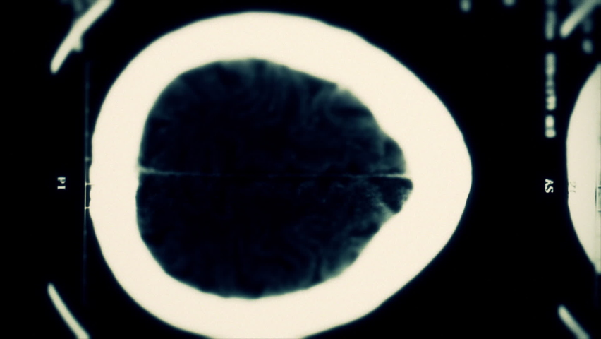 Close up of computed tomography scans of a human head moving erratically. Frame by frame. Seamless loop. Royalty-Free Stock Footage #1065153766