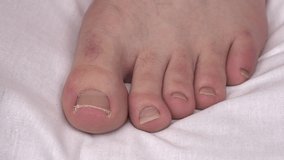 A man cuts his toenails close-up. Fungus nails are cut with special nippers.