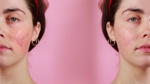Two half of faces of a young caucasian woman in close-up showing the result before and after rosacea treatment. Split screen. Pink background. The concept of couperose and rosacea.