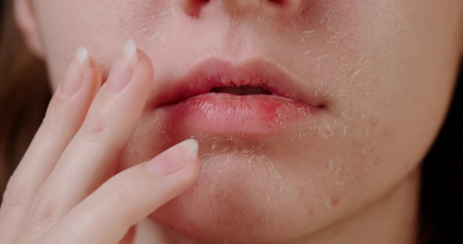 Flaky skin of a girl after cosmetic procedures | Shutterstock HD Video #1065419917