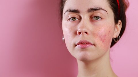 Close up portrait of a young Caucasian beautiful woman shows inflammation and couperose on the face. Pink background. The concept of rosacea