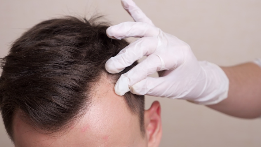 medical professional with gloves draws a dotted line on the head of a balding man. Royalty-Free Stock Footage #1065649387