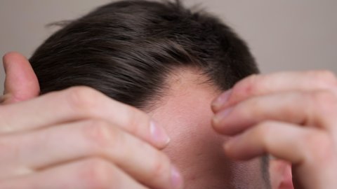 Man with bald spots suffering from hair loss. Treatment of hair problem.