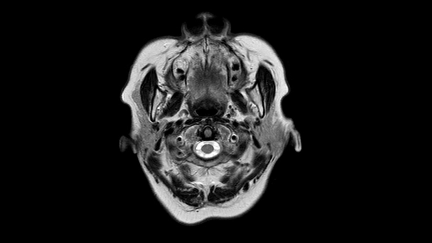 Time lapse of MRI na MRA brain scan of a human head,Stop motion view details seamless loop animation of the human head.Medical footage and techonology concept