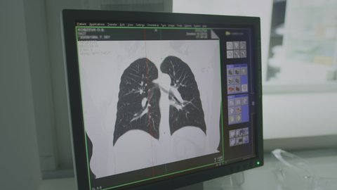 The result of a scan of the lungs on a computed tomograph. Lung model on a computer screen. CT Chest Coronal MIP. View with Lung filter technique for diagnosis TB, tuberculosis and covid-19.