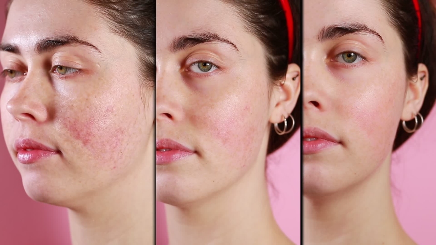 Face skin before after Stock Video Footage - 4K and HD Video Clips