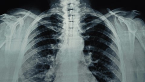 Doctor hand shows areas of affected lungs on chest x-ray film. Asthma, COVID-19, coronavirus or pneumonia diagnostic concept