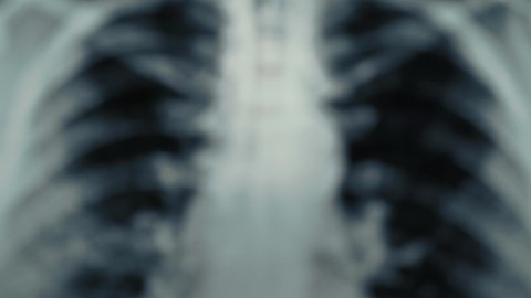 Radiological chest x-ray film, macro shot from blurred background. Asthma, COVID-19, coronavirus or pneumonia diagnostic concept