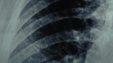 Panoramic macro shot of Radiological chest x-ray film. Asthma, COVID-19, coronavirus or pneumonia diagnostic concept