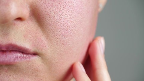 Macro skin with enlarged pores. The girl touches the irritated red skin with her fingers. Allergic reaction, peeling, care for problem skin.