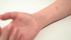 Closeup view 4k stock video footage of child's hand with red spot reaction to conducting Mantoux test after 72 hours from injection. Nurse in blue gloves checks skin reaction