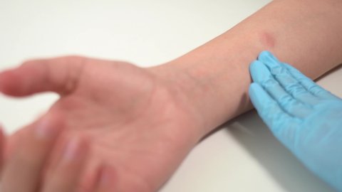 Closeup view 4k stock video footage of child's hand with red spot reaction to conducting Mantoux test after 72 hours from injection. Nurse in blue gloves checks skin reaction