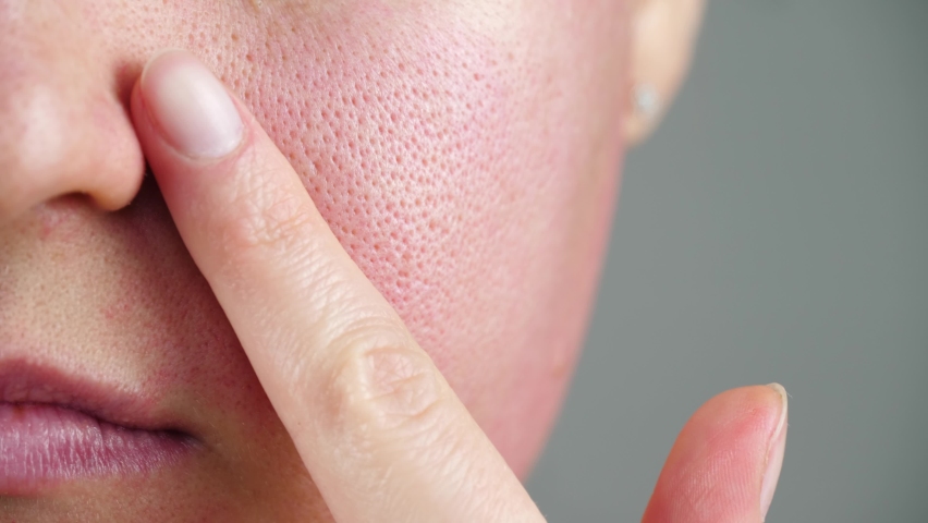 Skin texture with enlarged pores. Part of a woman's face close-up. Irritation, allergies, problem skin. Concept skincare. Beauty face. | Shutterstock HD Video #1066693423