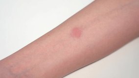 Closeup view 4k stock video footage of child's hand with red spot reaction to conducting Mantoux test after 72 hours from injection. Nurse in blue gloves applying transparent ruler to check reaction