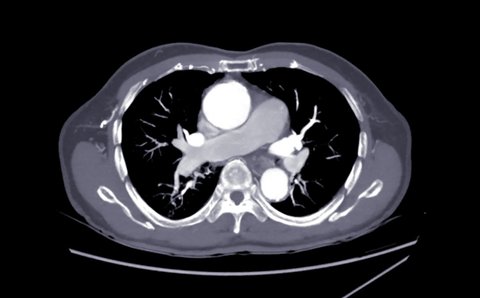 CTA whole aorta axial mip view 4k.