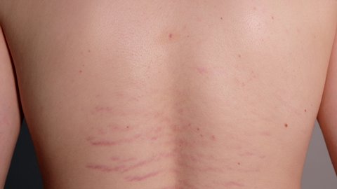 Close up view of young pearson's back with striae distensae (striae rubrae) background. The concept of impaired skin elasticity during puberty