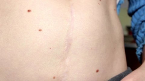 A healed scar on a woman's abdomen from a caesarean section. Close-up.