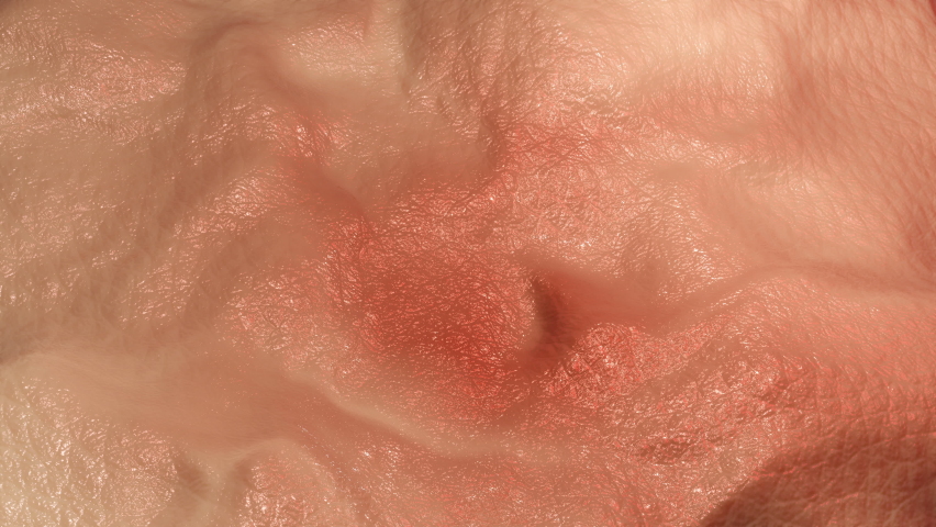 Medical 3D Animation of a close-up of skin inflammation causing red and irritated tissue. Royalty-Free Stock Footage #1066940059
