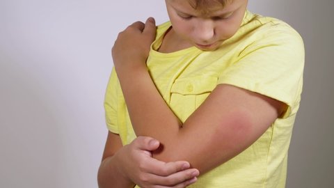 Closeup view stock video footage of caucasian cute kid looking sadly at big red spot on skin of arm caused by allergy reaction to vaccine