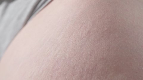 an overweight woman has scars on her thighs. the girl had scars after giving birth. the concept of the problem after stretching and tearing the skin during pregnancy.