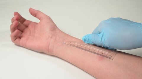 Closeup view 4k stock video footage of child's hand with red spot reaction to conducting Mantoux test after 72 hours from injection. Nurse in blue gloves applying transparent ruler to check reaction