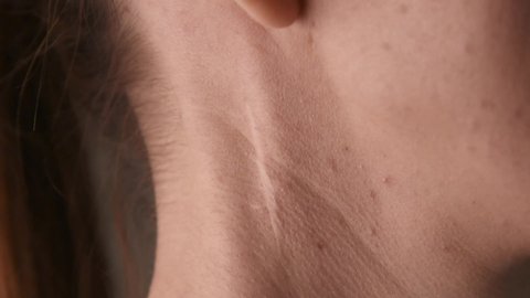 Close up surgery scar on beautiful woman neck.