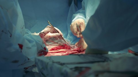 Surgeons are sewing up patient's stomach