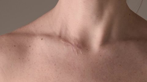 Close up shot of woman touching her surgical scar on collarbone near the neck.
