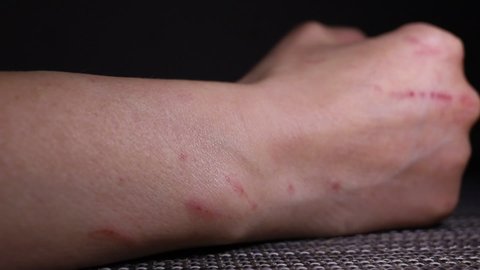 Closeup Scratch Marks On Woman Hand Stock Footage Video (100% Royalty ...