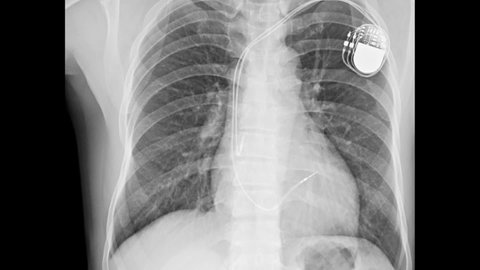 Zoom-in of the Chest x-ray image a human 64 year old on of permanent pacemaker implant in body chest.
Medical technology concept.