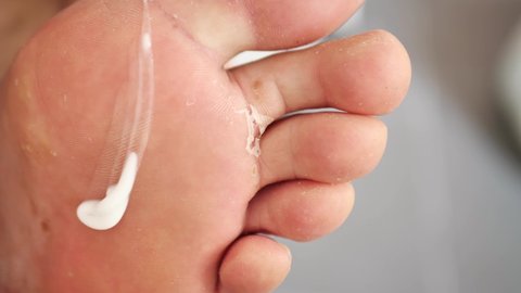 sore feet fungus. a man applies antifungal cream to the sole of his foot