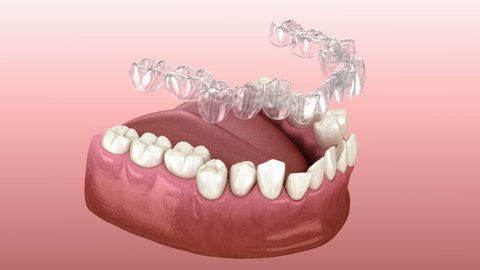 Invisalign braces or invisible retainer make bite correction. Medically accurate 3D animation