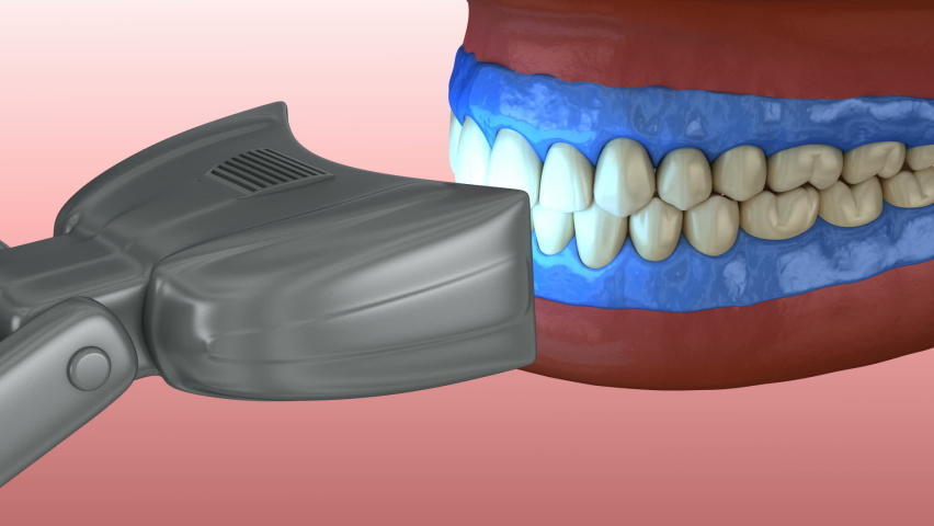 Proffesioinal teeth whitening, light-activation on tooth bleaching. 3D animation concept | Shutterstock HD Video #1068345041