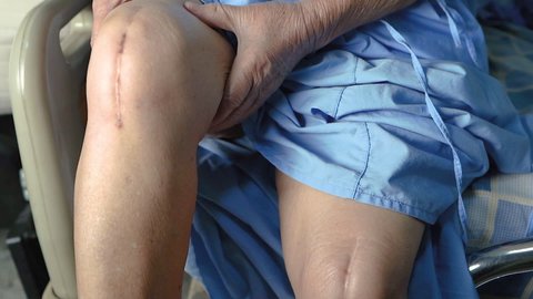 Massaging Asian senior or elderly old lady woman patient and show her scars surgical total knee joint replacement Suture wound surgery arthroplasty on bed in nursing hospital ward.