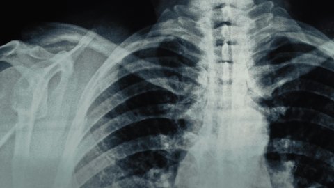 Radiological chest x-ray film, panoramic shot. Asthma, COVID-19, coronavirus or pneumonia diagnostic concept