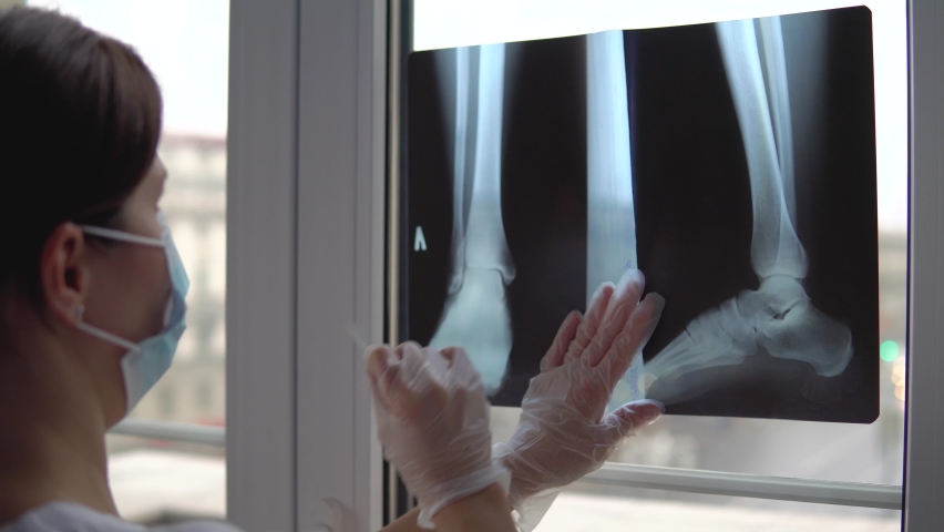 Doctor examines x-ray film of broken leg Royalty-Free Stock Footage #1068774557