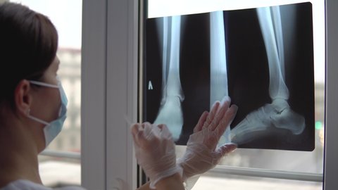 Doctor examines x-ray film of broken leg