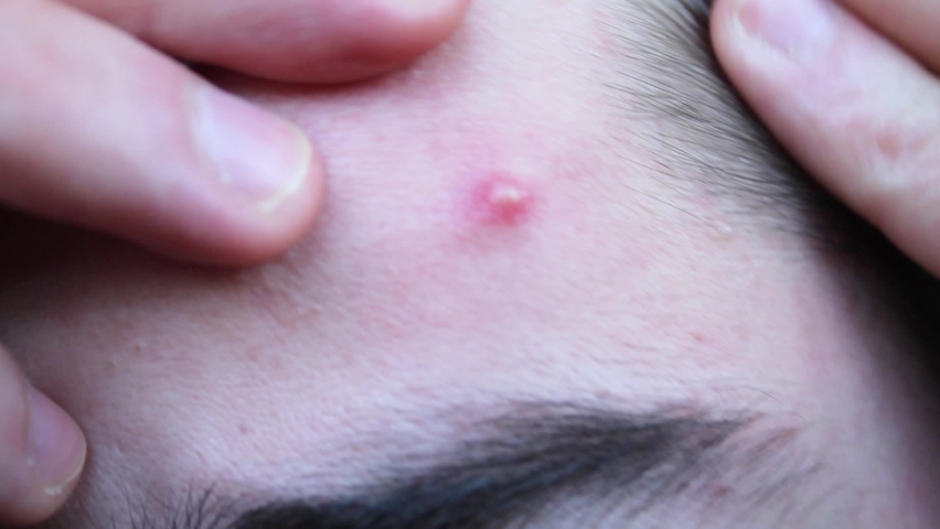 Problematic skin in a young man with dark hair. Acne on the forehead. Problem of teenage acne and pimples on face skin. | Shutterstock HD Video #1068825539