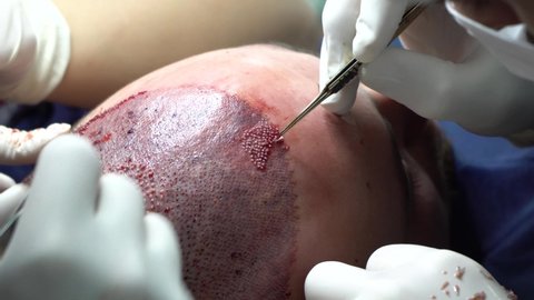Patient's head close-up. Baldness treatment. Hair transplant. Surgeon in the operating room carry out hair transplant surgery. 
