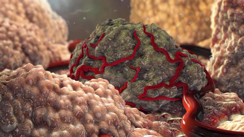Cancer Tumor Cells 3D Illustration | Shutterstock HD Video #1068960575