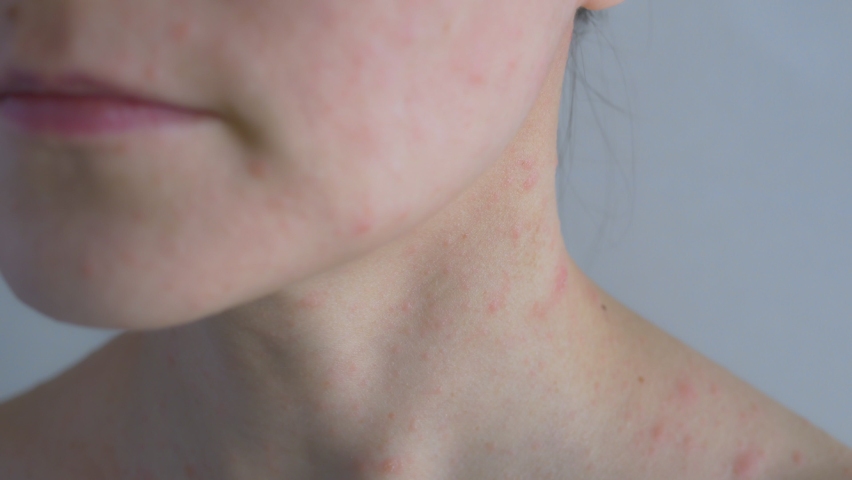 Woman with problem skin. Close-up shot of a video with an allergic reaction on the skin. On the face and neck, skin inflammation is light red. Allergic dermatitis. | Shutterstock HD Video #1069078372