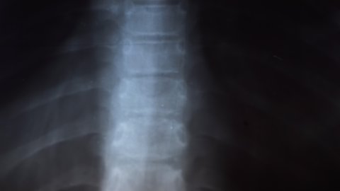 X-ray of Spine, Ribs, Bones of a Small Child. Curvature of spine. Kyphosis. 4K
