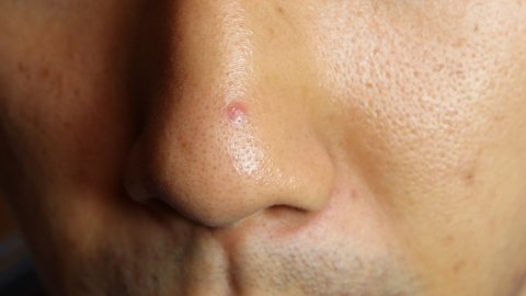 A close-up of an Asian man's nose. A red pimple has developed.