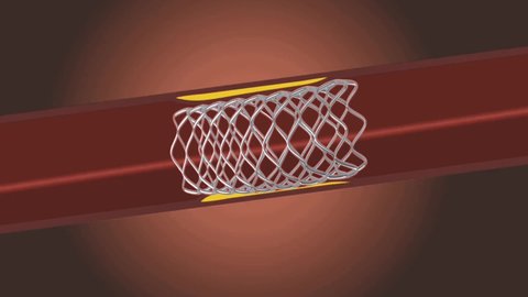 Human Balloon Angioplasty Medical Health function human body isolated  background 
