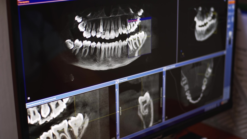 Dentist is working with radiology x-ray of upper and lower jaws on computer display Royalty-Free Stock Footage #1069401589