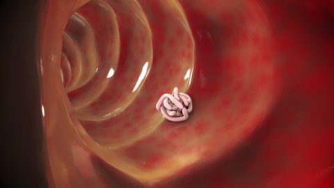 Parasitic worms in the intestinal lumen, 3D animation. Growth and multiplication of nematode worms invading human intestine