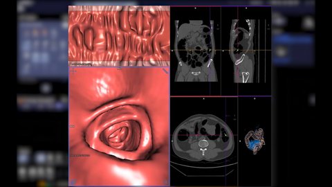 CT colonography  3D rendering movie showing intra colon for screening colorectal cancer. Check up Screening cancer of colon.