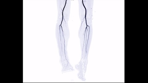 CTA Leg or CT angiography of the leg turn around on the screen for detect peripheral arterial disease.