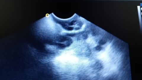 polycystic ovary by ultrasound scan